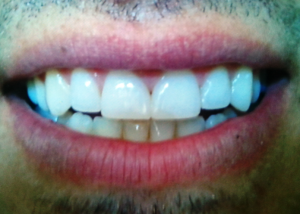 murrayutahveneers